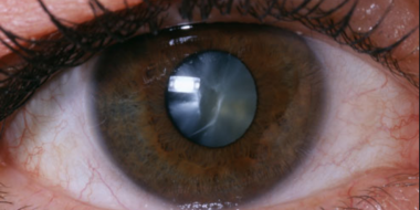 cataract